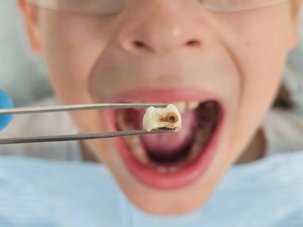 Best Emergency Root Canal Treatment in Cache, OK