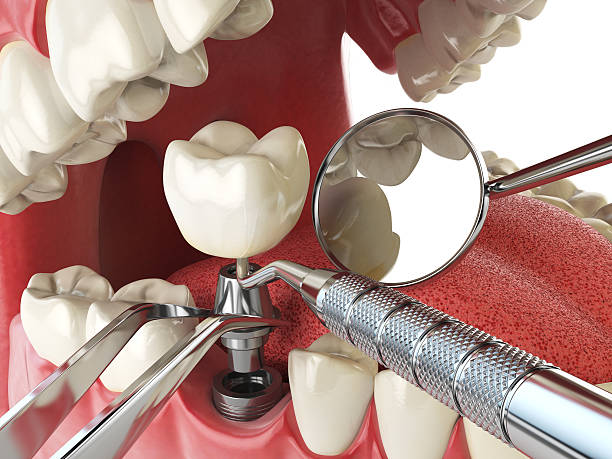 Best Emergency Tooth Extraction in Cache, OK